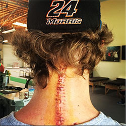 Bradley Morris neck injury surgery